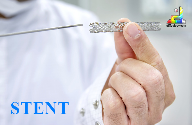 What is a Stent