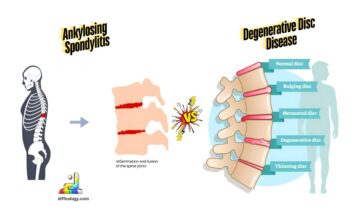 Difference Between Ankylosing Spondylitis and Degenerative Disc Disease