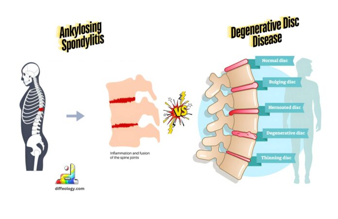 Difference Between Ankylosing Spondylitis and Degenerative Disc Disease