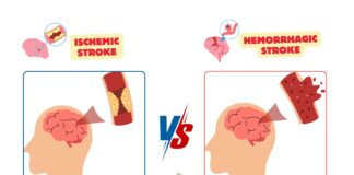 Difference Between Ischemic and Hemorrhagic Stroke