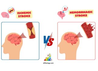 Difference Between Ischemic and Hemorrhagic Stroke