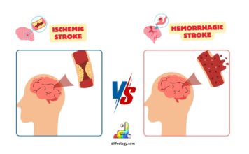 Difference Between Ischemic and Hemorrhagic Stroke