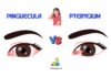 Difference Between Pinguecula and Pterygium