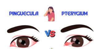 Difference Between Pinguecula and Pterygium