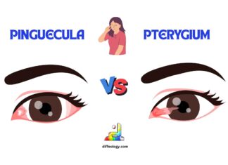 Difference Between Pinguecula and Pterygium