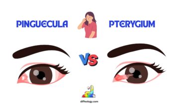 Difference Between Pinguecula and Pterygium