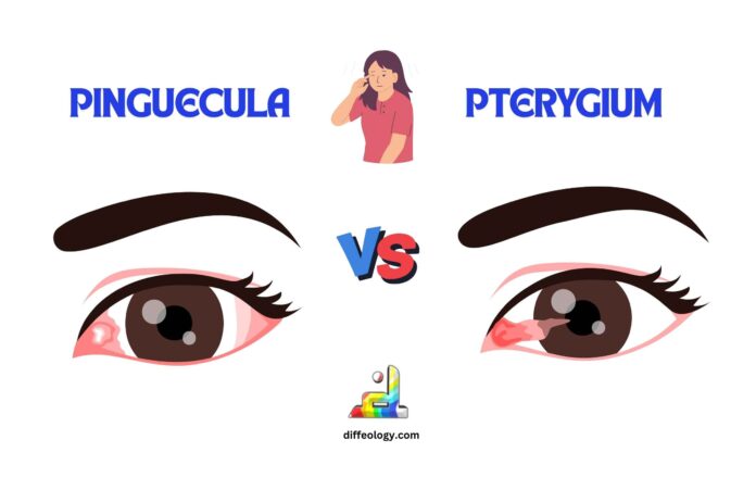 Difference Between Pinguecula and Pterygium