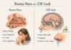 DIfference Between Runny Nose and CSF Leak